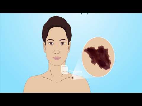 STINA E VERËS, SI TË KUJDESEMI PËR LËKURËN