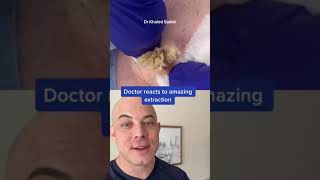 Derm reacts to massive blackhead extraction! #dermreacts #doctorreacts #pimplepop #blackheads