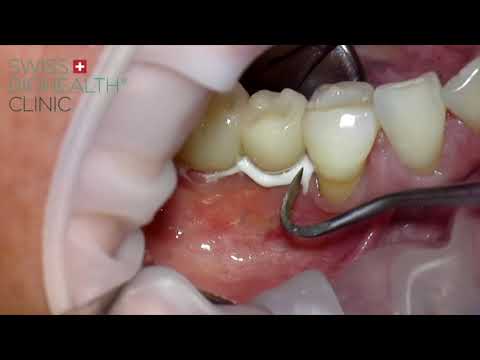 Finale prothetische Versorgung