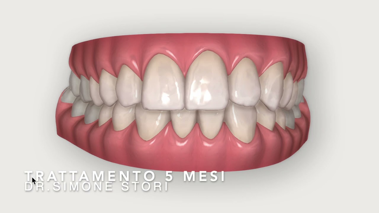Invisalign Prima e Dopo - Dente Sporgente - Ortodonzia Bologna