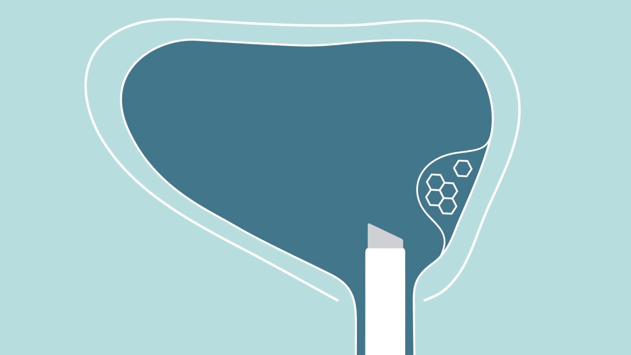 Bladder Tumor Removal with TURBT - Urology Care Foundation