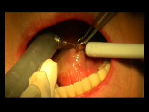 Hpv cancer throat treatment