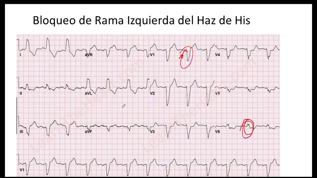 Desviación del Eje a la Izquierda en Bloqueo de Rama Izquierda