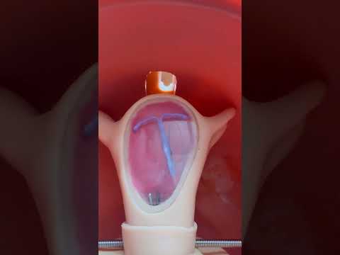 Schwierige Entfernung der Spirale