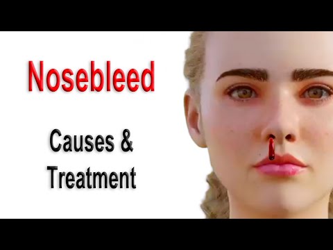 Nosebleed Causes and Treatment
