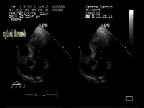 Left Ventricular Apical Cystic Thrombus (1/2)