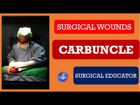 CARBUNCLE-  How To DIAGNOSE & TREAT / SURGICAL INFECTIONS