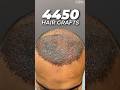 4450 Hair Grafts | Sapphire FUE Hair Transplant By Dr. Mohd Asif at CARA