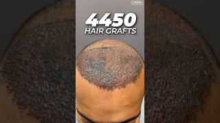 4450 Hair Grafts | Sapphire FUE Hair Transplant By Dr. Mohd Asif at CA