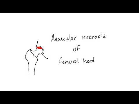 Ficat and Arlet Classification | AVN | Mindfulortho