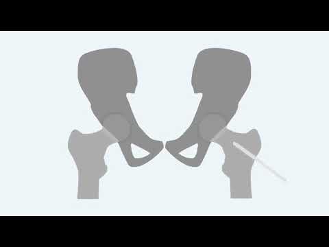 Predicting Risk of Contralateral Slip in Unilateral Slipped Capital Femoral Epiphysis