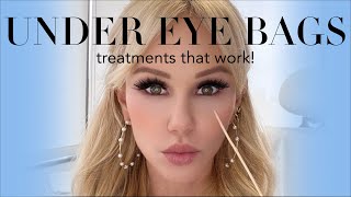 Get rid of your UNDER EYE BAGS! Treatments that WORK!