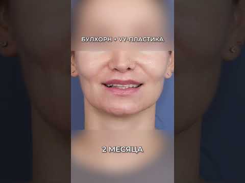 Восстановление после пластики губ / Булхорн + VY-пластика ️❗ Мой телеграм: dr_gretskova