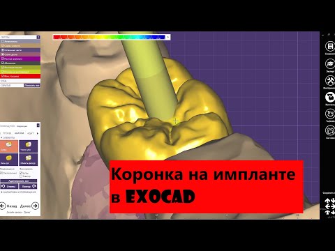 Цирконий на Импланте в exocad. Моделировка коронки на имплантатах в цифре. Моделирование зубов