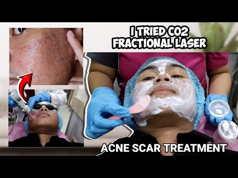 ACNE SCAR TREATMENT: I TRIED CO2 FRACTIONAL LASER | SUBCISION FOR ACNE SCARS