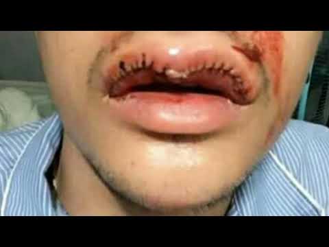 Peningkatan dalam forum anggota Anggota Society of Plastic Surgeons Rekonstruksi dan Estetik