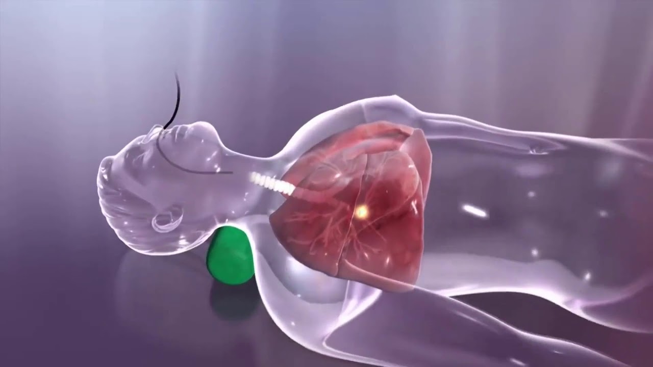 El lupus es una discapacidad