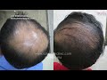 Mesotherapy for hair loss in Delhi Mesotherapy Treatment by Satya