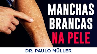 Solar Leukoderma – White Spots on the Skin of the Arms and Legs – Dr. Paulo Muller, Dermatologist