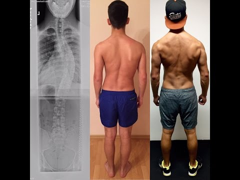 Kreuzheben 110kg mit Skoliose / Deadlift 242lbs with scoliosis