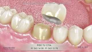 Prótesis dental fija - puentes, coronas y carillas. - Nadia Sarmini Fernández