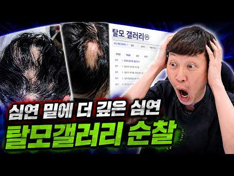 탈모인을 울리는 탈모갤러리 잘못된 정보들! 전부 바로 잡아드립니다