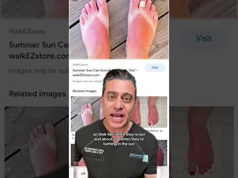 The danger of skipping sunscreen on your feet