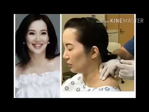 Bumili sa parmasya mikozan lungsod kagawaran ng kalusugan Kung paano gamutin ang kuko halamang-singaw Candida