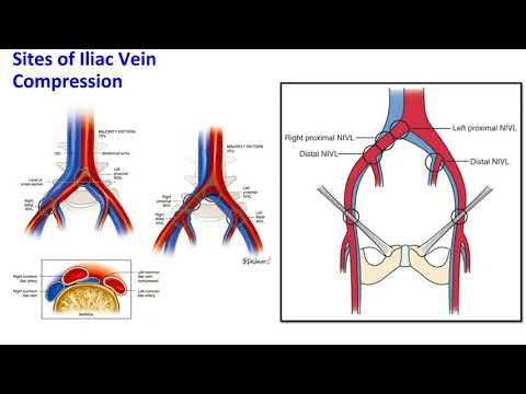 FL Cardiology Testimonial - Bilateral Iliac Vein Stenting 3