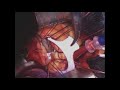 Upper Ministernotomy Aortic Valve Replacement And Ascending Aortic Replacement