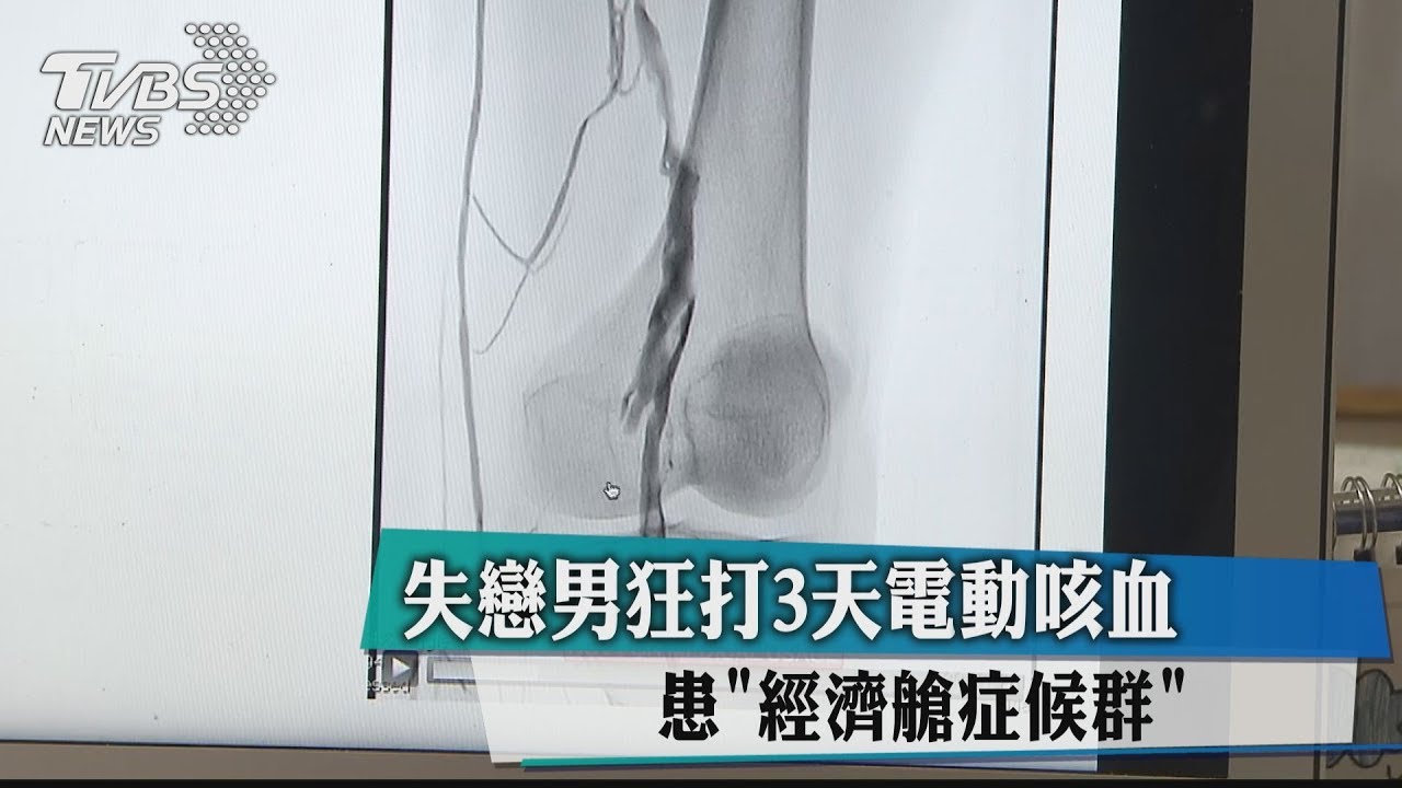 失戀男狂打3天電動咳血 患「經濟艙症候群」