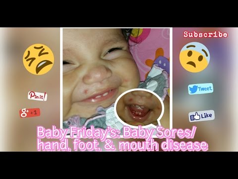 Eksema sa mga kamay ng mga halamang-singaw sa kanyang mga paa Unguento ng fungus sa mucosa sa intimate zone