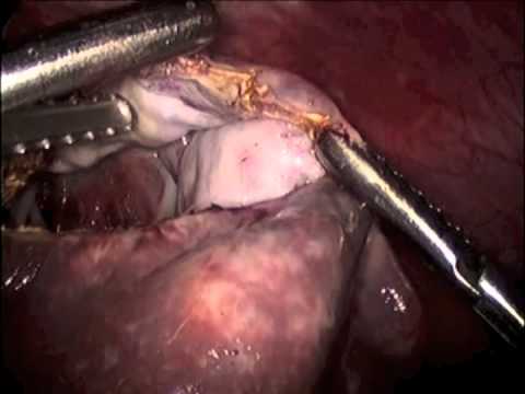 Escisión laparoscópica de un quiste con conservación del bazo