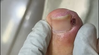 Ep_8657 Big ingrown toenail removal 👣 ทำไมถึงห้ามผมทำแบบนี้ครับ  🙂 (clip from Thailand)