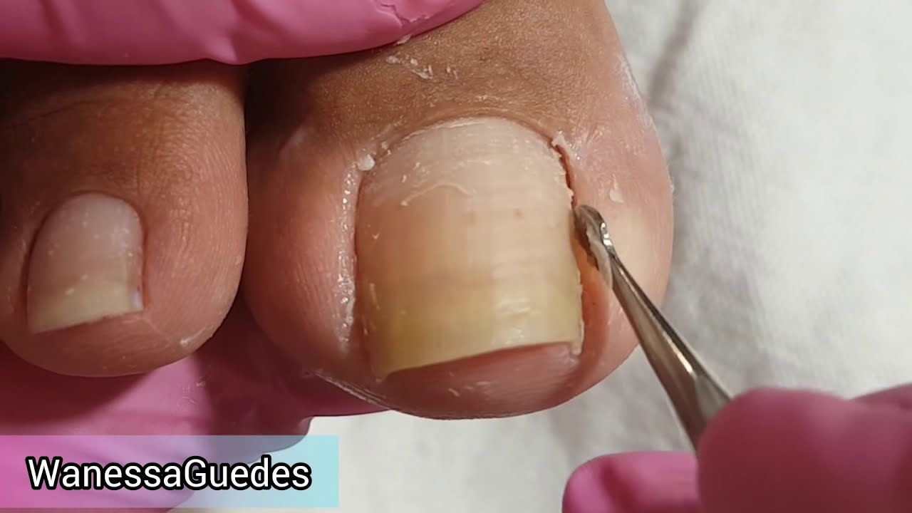 Cutilagem Do Pé Passo a Passo