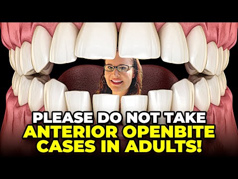 Please DO NOT TAKE OPENBITE CASES IN ADULTS! AOB