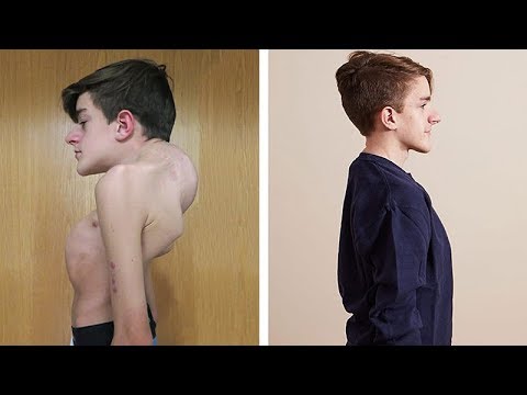 Overcoming a severe spinal deformity