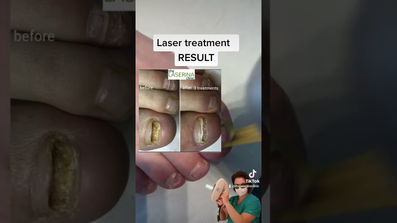 Fungal toes Laser treatment RESULT