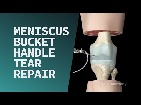 Meniscus Bucket Handle Tear Repair