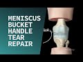 Meniscus Bucket Handle Tear Repair