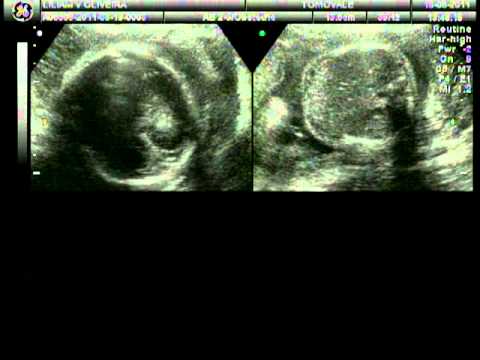 Ultrason Bianca Gabrielle 19/08/2011