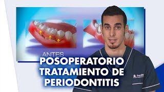 ¿Cómo es el POSOPERATORIO del tratamiento de la PERIODONTITIS | #Shorts