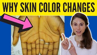 WHY YOUR SKIN COLOR CHANGES | Dermatologist @DrDrayzday