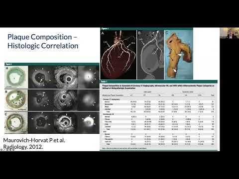 Sponsored webinar | Advanced coronary plaque analysis & next generation FFRCT in clinical care