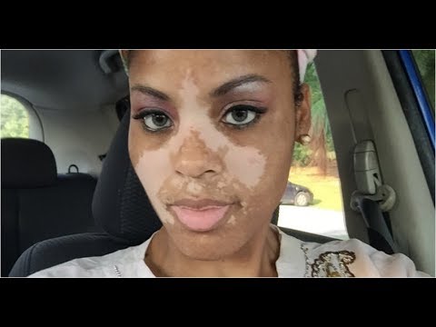 Comprare la crema che candeggia akhromin le risposte La decolorazione di medicina per pelle da ustioni