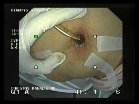 Gastrostomy Granuloma - Laserotherapy