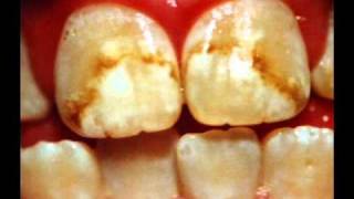 Your Teeth are Yellow