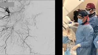 Transradial Repeat PAE with n-BCA Liquid Embolic for Recurrent LUTS