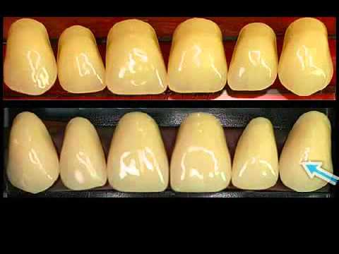 Unterschiede bei Zahnprothesen