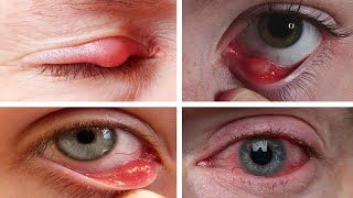 How to Get Rid of a Stye Overnight at Home || 6 Home Remedies for Stye On Your Eye